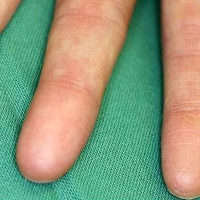 Могут ли у человека с рождения отсутствовать отпечатки пальцев?