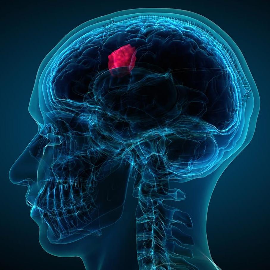 Какую своевременную операцию на головном мозге одной пациентке сделали благодаря её галлюцинациям?